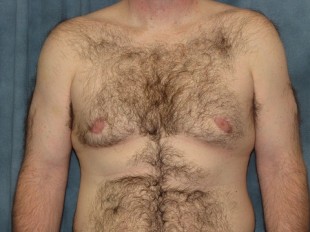 Male Patient 4 – Gynecomastia