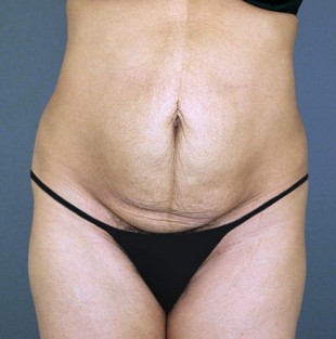 Tummy Tuck Patient 14