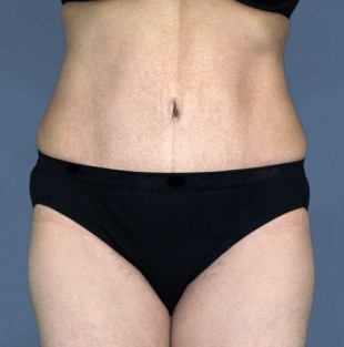 Tummy Tuck Patient 14