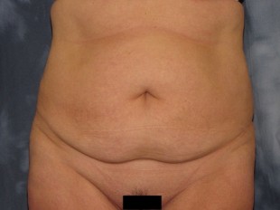 Tummy Tuck Patient 11