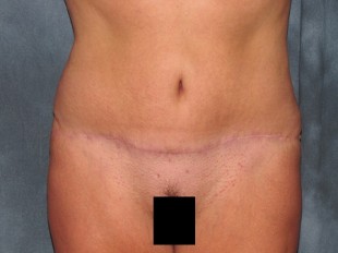 Tummy Tuck Patient 11