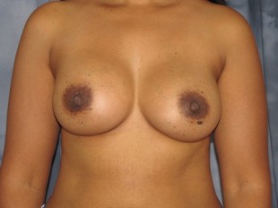Breast Augmentation Patient 26