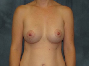 Breast Augmentation with Lift Patient 21