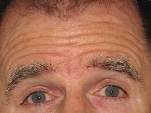 Botox and Juvederm Patient 4