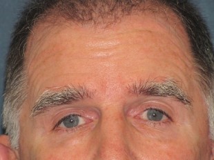 Botox and Juvederm Patient 4