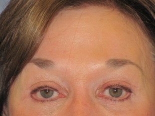 Botox and Juvederm Patient 3
