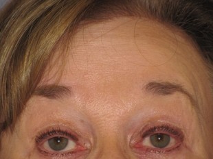 Botox and Juvederm Patient 3