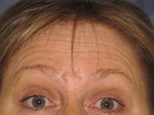 Botox and Juvederm Patient 1