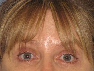 Botox and Juvederm Patient 1