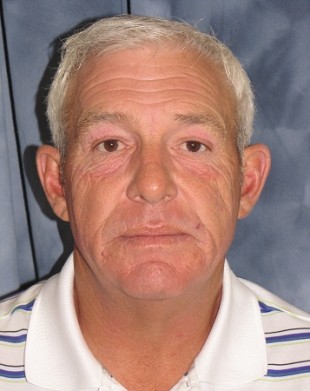 Male Patient 10- Facelift