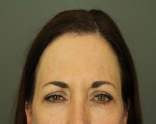 Botox and Juvederm Patient 6