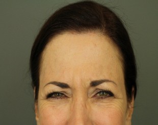 Botox and Juvederm Patient 6