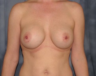 Complex Revisionary Breast Patient 1