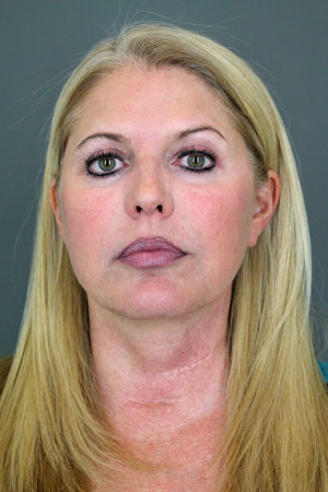 Patient Spotlight: Facelift Before & After