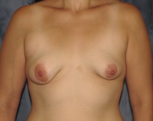 Breast Augmentation with Lift Patient 22