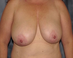 Breast Reduction Patient 13