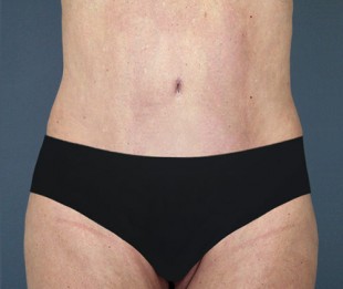 Tummy Tuck Patient 13