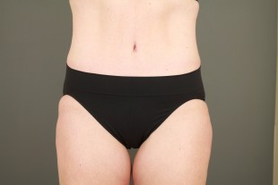 Tummy tuck 10-2