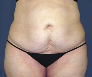 Tummy Tuck Patient 12