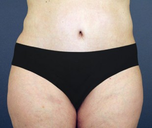 Tummy Tuck Patient 12