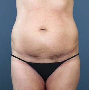 Tummy Tuck Patient 7