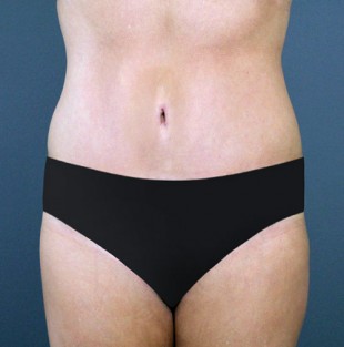 Tummy Tuck Patient 7