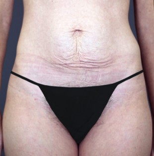 Tummy Tuck Patient 8