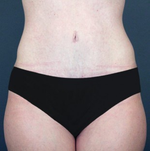 Tummy Tuck Patient 8