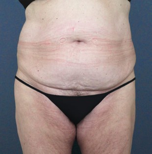 Tummy Tuck Patient 6