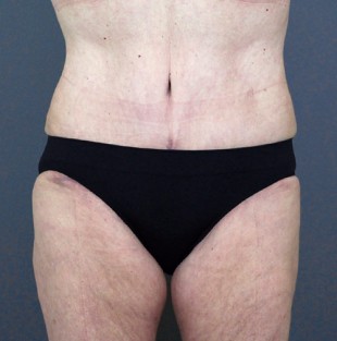 Tummy Tuck Patient 6