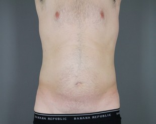 Male Patient Liposuction 13