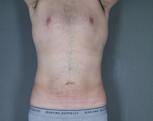 Male Patient Liposuction 13