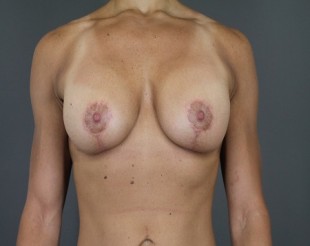 Complex Revsionary Breast Case 4