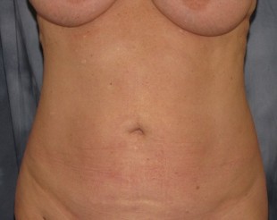 Liposuction Patient 11