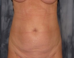Liposuction Patient 11