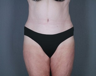 Tummy Tuck Patient 20