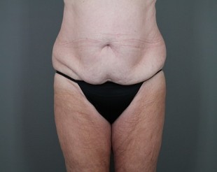 Tummy Tuck Patient 20