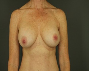 Complex Revisionary Breast Case Patient- 5