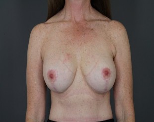 Complex Revisionary Breast Case Patient- 5