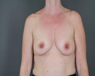 Breast Augmentation Patient 35