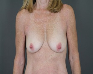 Breast Augmentation with Lift Patient 26