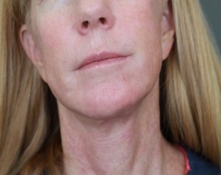 Juvederm Patient 8