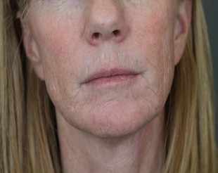 Juvederm Patient 8