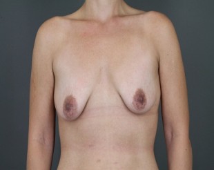 Breast Augmentation with Lift Patient 27