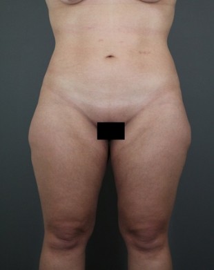 Liposuction Patient 14