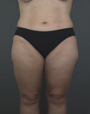 Liposuction Patient 14