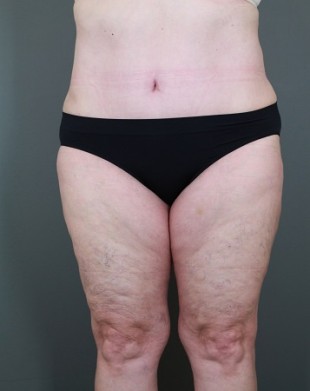 Tummy Tuck Patient 17