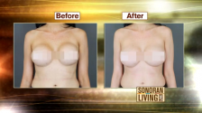 Dr Flint - Sonoran Living Live Breast Augmentation