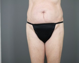 Tummy Tuck Patient 17