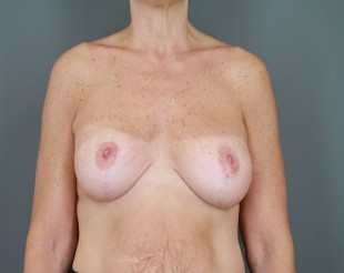 Breast Augmentation with Lift Patient 29